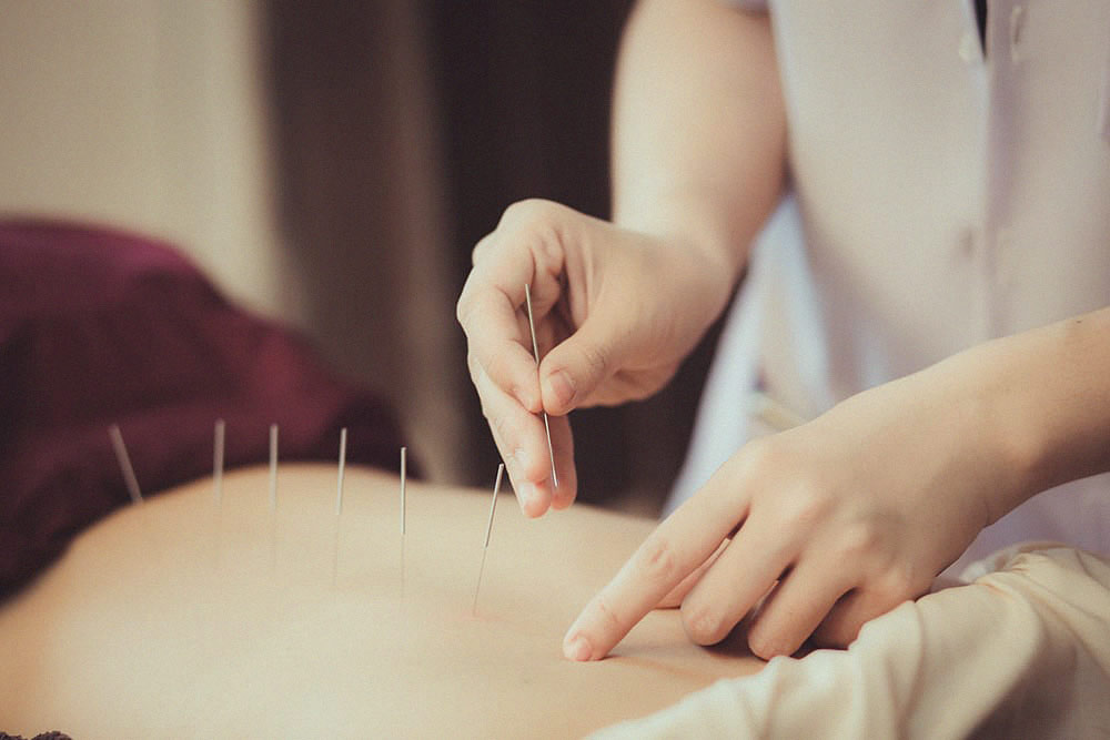 acupuntura-fisioterapia.jpg